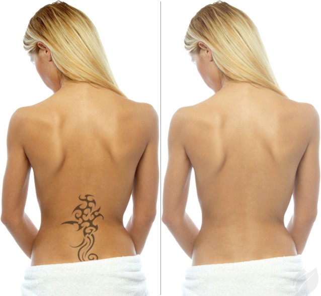 Laser Tattoo Removal | NURISS Skincare and Wellness Centre
